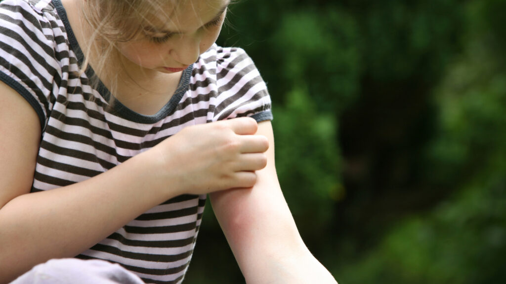 A girl wishing she had used something to help her keep mosquitoes away to avoid bug bites